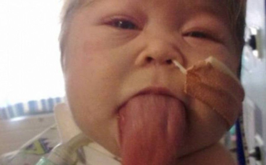 Γεννήθηκε με γλώσσα που δεν σταματούσε να μεγαλώνει (pics)