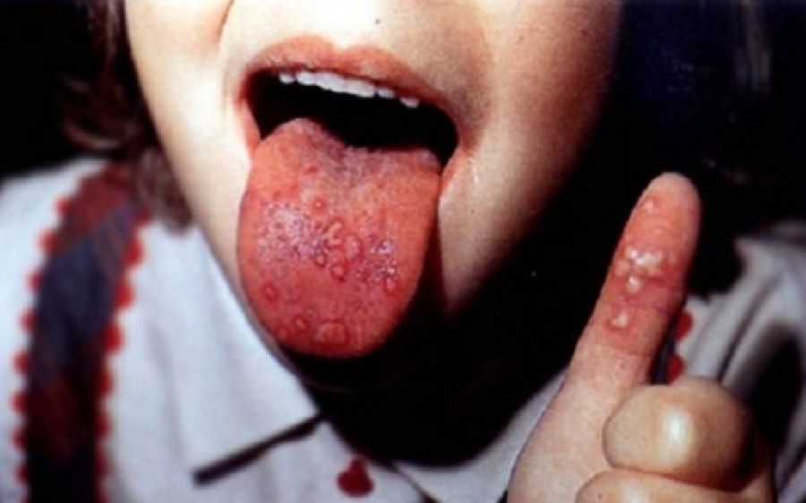 «Τι είναι ο ιός Coxsackie;». Συμβουλεύει η παιδίατρος Μαριαλένα Κυριακάκου