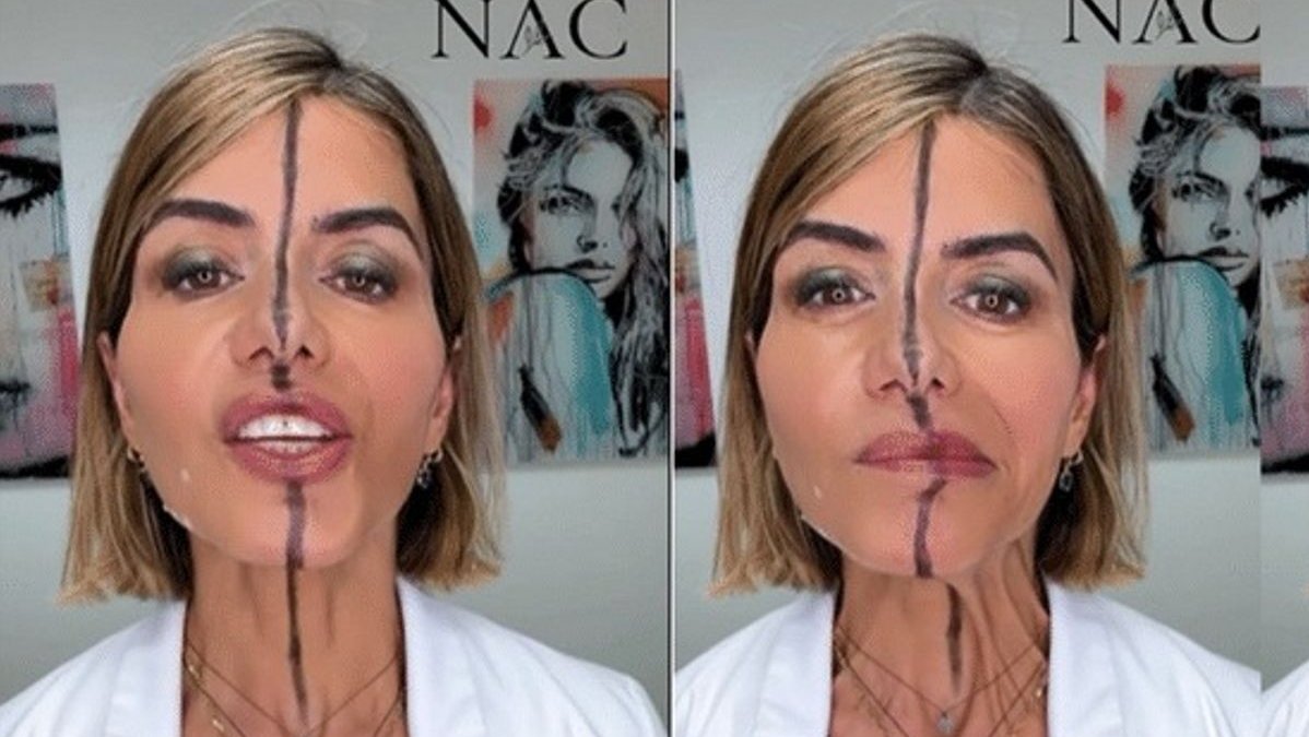 Η γιατρός που έκανε botox μόνο στο μισό της πρόσωπο για να δείξει τις αληθινές επιδράσεις του