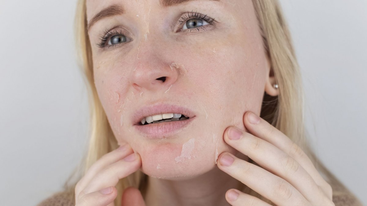 Μήπως βγάλατε το “εξάνθημα του χειμώνα” τώρα που κρύωσε ο καιρός;