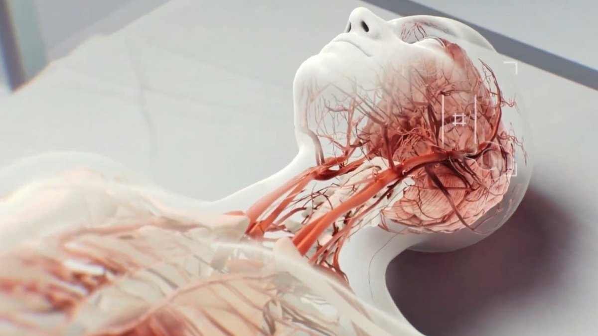 Πρόληψη εγκεφαλικού: Μικρορομπότ κολυμπούν στα αγγεία και διαλύουν θρόμβους αίματος [video]