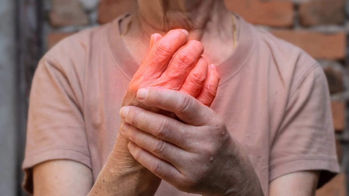 Καυστικός πόνος και πρήξιμο στο δέρμα; Ίσως έχετε ερυθρομελαλγία