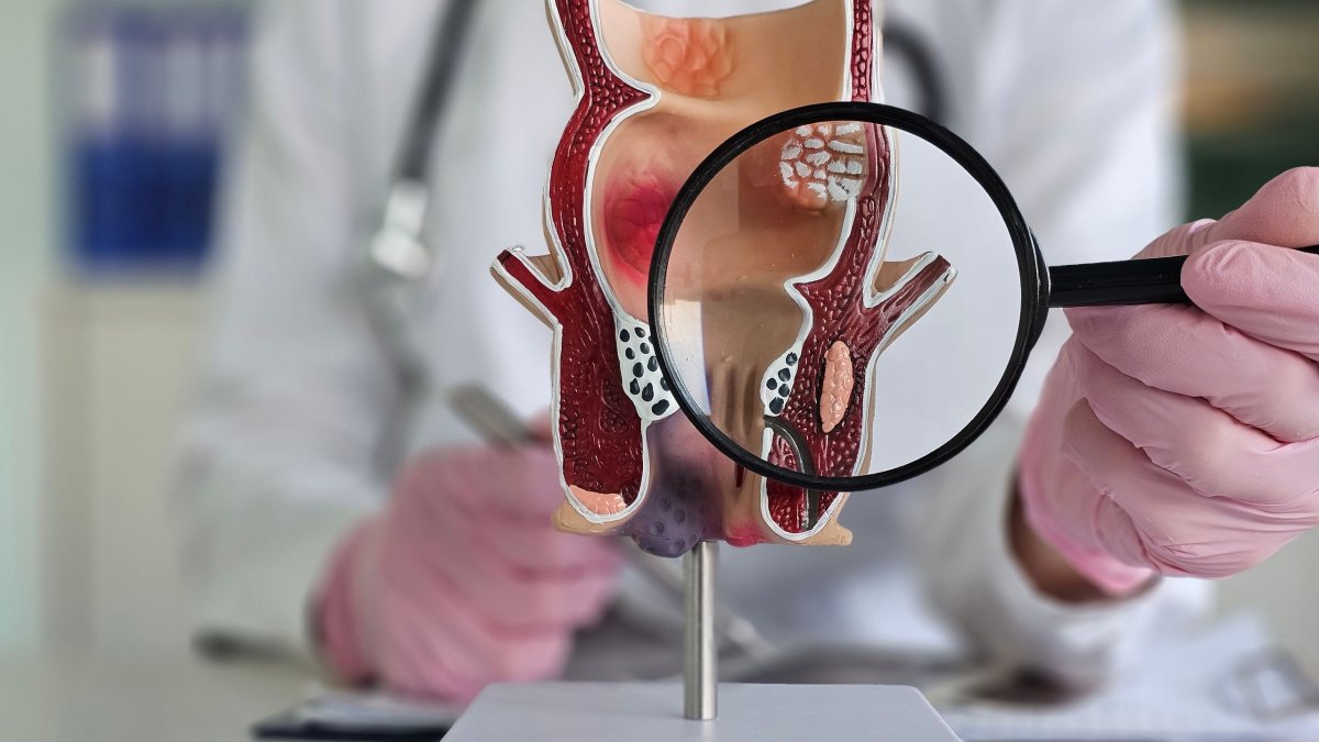 Καρκίνος του Ορθού – Ενδεδειγμένες Θεραπευτικές Επιλογές