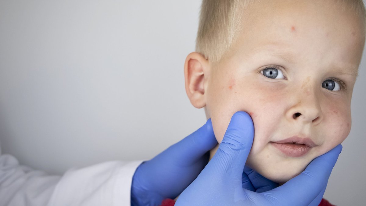 Ποια νόσος που δεν έχει θεραπεία ήταν σε ύφεση, αλλά εξαπλώνεται ξανά παγκοσμίως