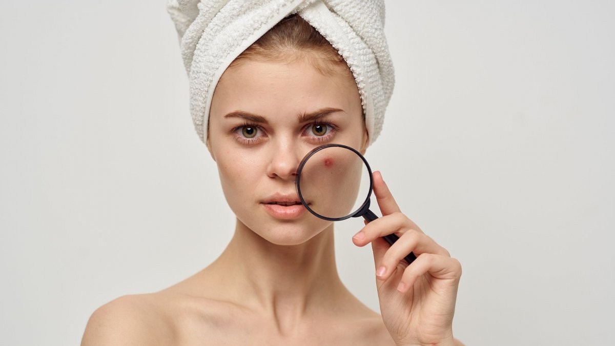 Πώς να αφαιρέσετε τα μαύρα στίγματα για να μην μείνουν σημάδια