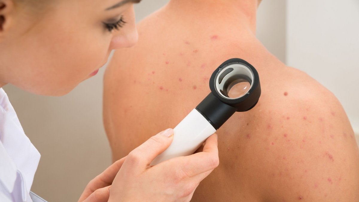 Διαπυητική ιδρωταδενίτιδα: Η δερματική πάθηση που συχνά συγχέεται με ακμή