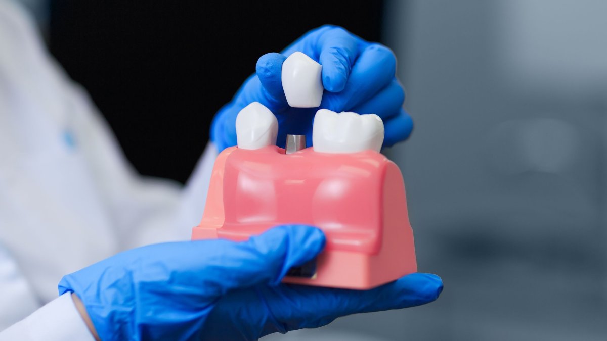 Προσοχή σε εμφυτεύματα χαμηλού κόστους - Οι οδοντίατροι προειδοποιούν για παραπλάνηση του κοινού