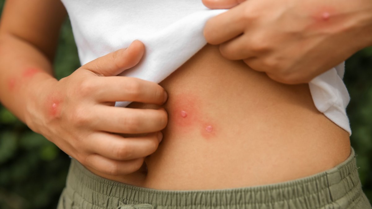 Τι δείχνει αν βγάλετε έκζεμα στο στομάχι – Τι να προσέχετε