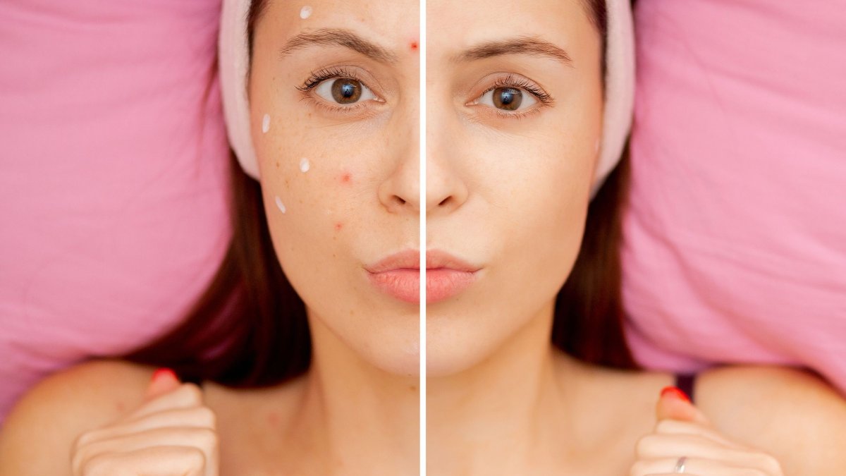 Είναι η υδροκορτιζόνη μια καλή θεραπεία για την ακμή;