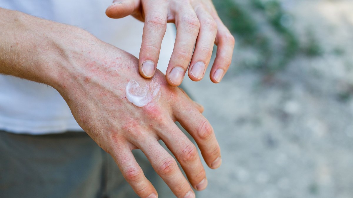 Όλα όσα πρέπει να γνωρίζετε για τις δερματικές λοιμώξεις