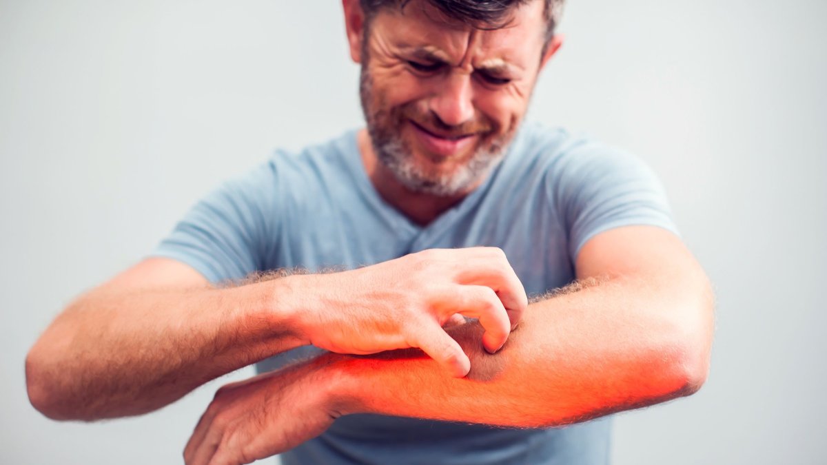 Πώς να μειώσετε τη φαγούρα του εκζέματος χωρίς να το επιδεινώσετε