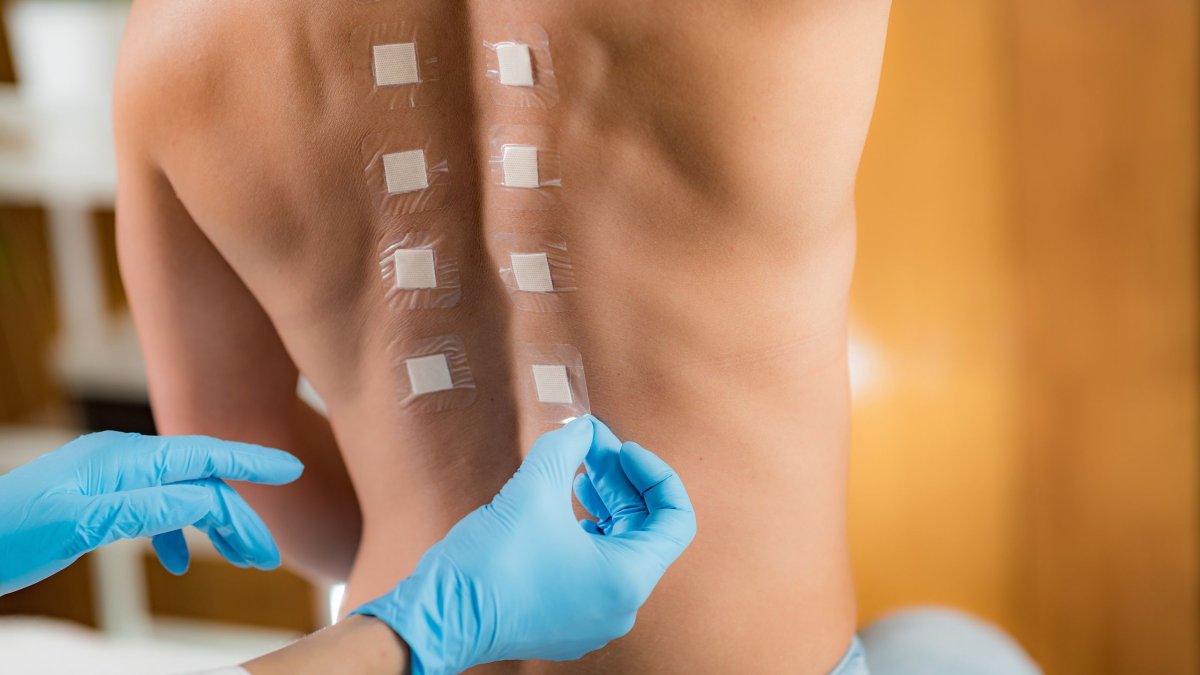Αλλεργικές αντιδράσεις: Πώς γίνεται ένα τεστ επικόλλησης στο δέρμα