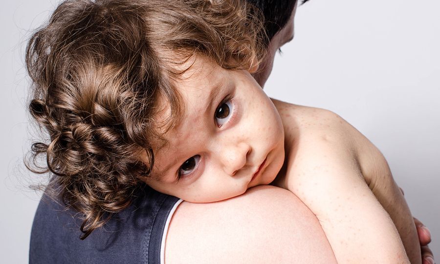 Ιλαρά: «Εύθραυστη» η ισορροπία στην Ευρώπη - Το «παράθυρο» επανεμφάνισης και ο κίνδυνος από τις ΗΠΑ