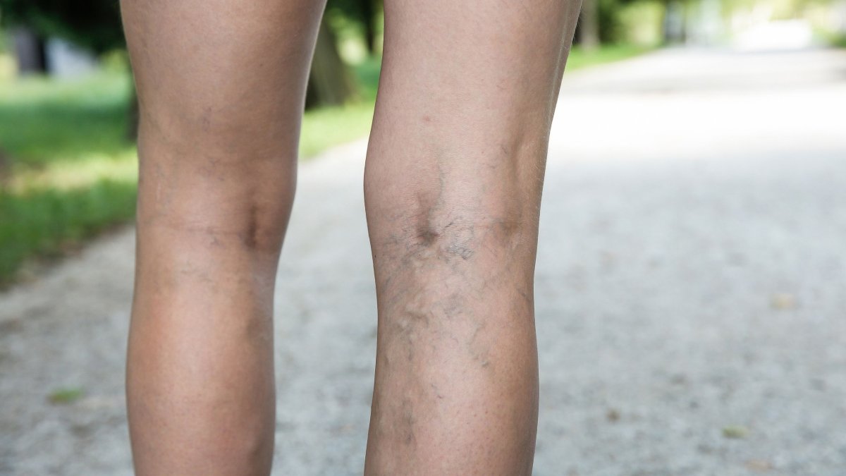 Χαρτογράφηση ευρυαγγειών: Η σύγχρονη αντίληψη στη θεραπευτική τους