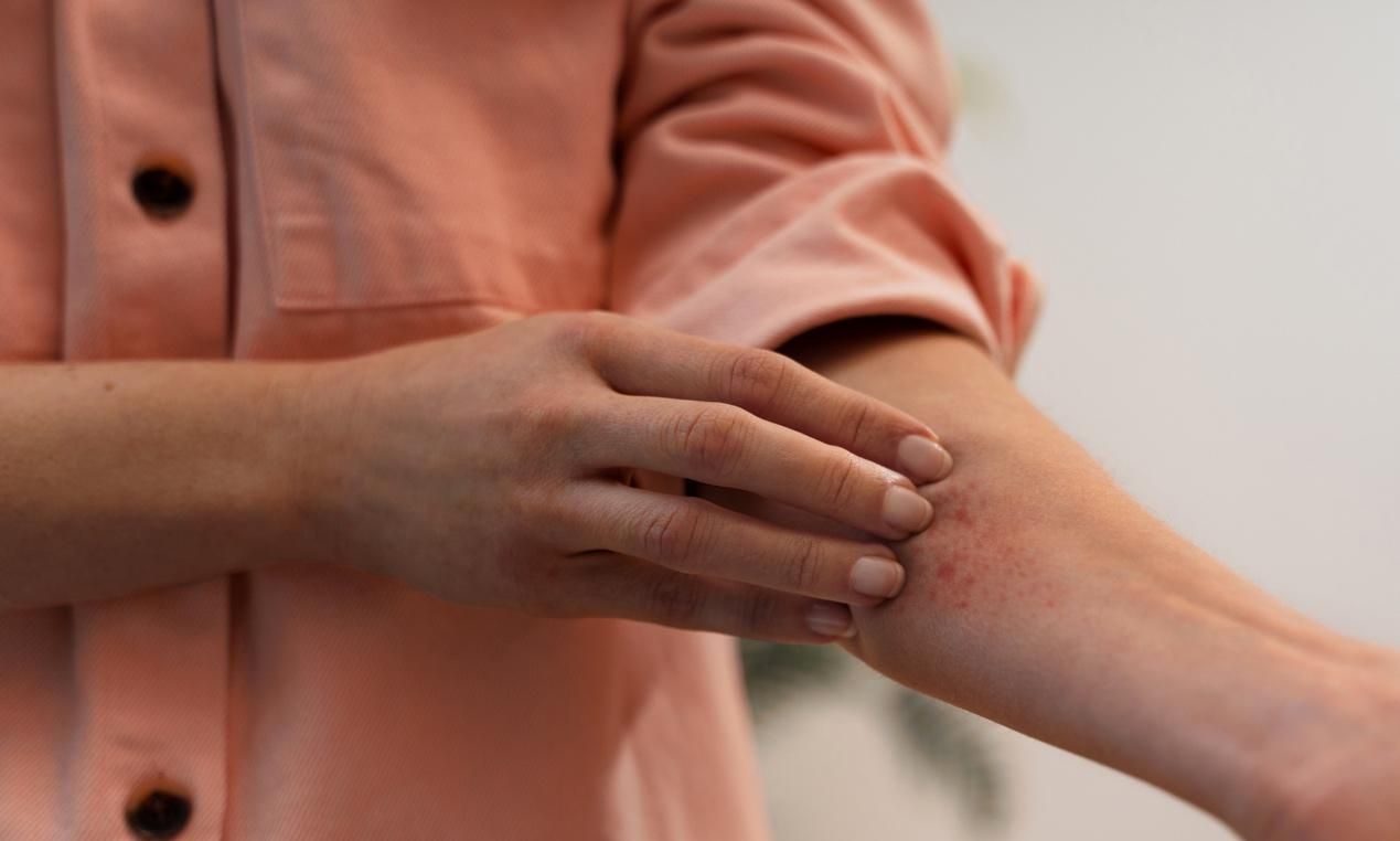 &Alpha;&tau;&omicron;&pi;&iota;&kappa;ό &delta;έ&rho;&mu;&alpha;: &Pi;ώ&sigmaf; &eta; &sigma;&omega;&sigma;&tau;ή &pi;&epsilon;&rho;&iota;&pi;&omicron;ί&eta;&sigma;ή &tau;&omicron;&upsilon; &alpha;&pi;&omicron;&kappa;&alpha;&theta;&iota;&sigma;&tau;ά &tau;&omicron;&nu; &delta;&epsilon;&rho;&mu;&alpha;&tau;&iota;&kappa;ό &phi;&rho;&alpha;&gamma;&mu;ό