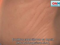 Δείτε πού οφείλεται η εμφάνιση ραγάδων στο σώμα (video)