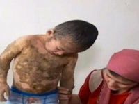 Η ανατριχιαστική περίπτωση του παιδιού με δέρμα "σαύρας" (φωτογραφίες)