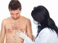 Κρούσματα ανεμοβλογιάς στην Ειδομένη: Νέοι εμβολιασμοί και πιθανή επίσκεψη Ξανθού στον καταυλισμό
