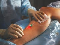 Κιρσοί: Μην βάζετε φρένο στη ζωή σας, θεραπεύστε τους οριστικά