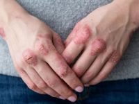 Χρόνιο έκζεμα χεριών: O FDA ενέκρινε την πρώτη κρέμα για τη θεραπεία της πάθησης