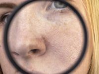 Μαύρα στίγματα στην μύτη: Δερματολογικά εγκεκριμένοι τρόποι για να τα αφαιρέσετε