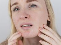 Μήπως βγάλατε το “εξάνθημα του χειμώνα” τώρα που κρύωσε ο καιρός;