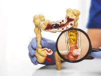 Κάθε πότε πρέπει να κάνετε κολονοσκόπηση ανά ηλικία και επίπεδο κινδύνου