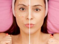 Είναι η υδροκορτιζόνη μια καλή θεραπεία για την ακμή;