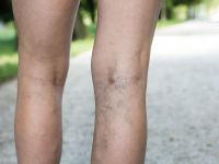 Χαρτογράφηση ευρυαγγειών: Η σύγχρονη αντίληψη στη θεραπευτική τους