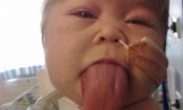 Γεννήθηκε με γλώσσα που δεν σταματούσε να μεγαλώνει (pics)