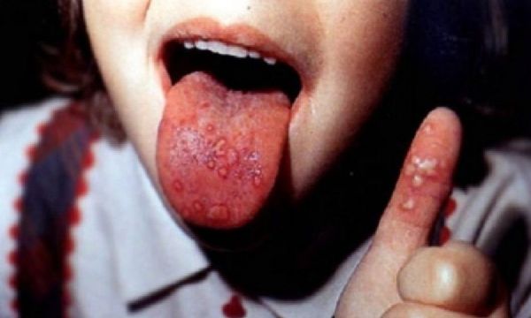 «Τι είναι ο ιός Coxsackie;». Συμβουλεύει η παιδίατρος Μαριαλένα Κυριακάκου