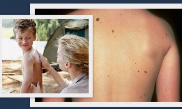 Ευρωπαϊκή Ημέρα Μελανώματος-Τι πρέπει να γνωρίζετε για τις ελιές στο δέρμα των παιδιών
