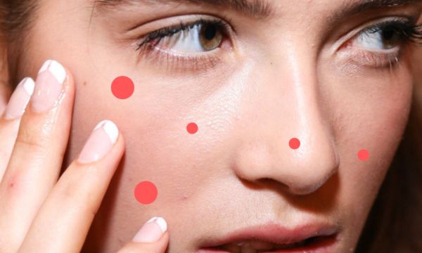 «Έβγαλα σπυράκι, ξαφνικά. Τι να κάνω»; Διάβασε εδώ