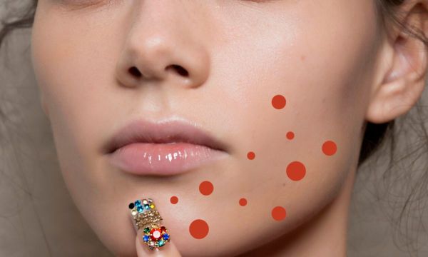 Τα σπυράκια που έβγαλες μπορεί να οφείλονται στο στρες… Θα σου εξηγήσουμε.