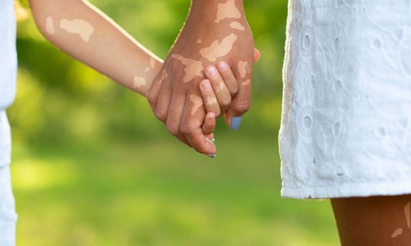 Διαταραχές μελάγχρωσης στα παιδιά: Τι πρέπει να γνωρίζετε