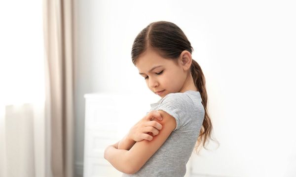 Μωρά και νήπια με έκζεμα: Τροφές που πρέπει να αποφεύγονται (εικόνες)