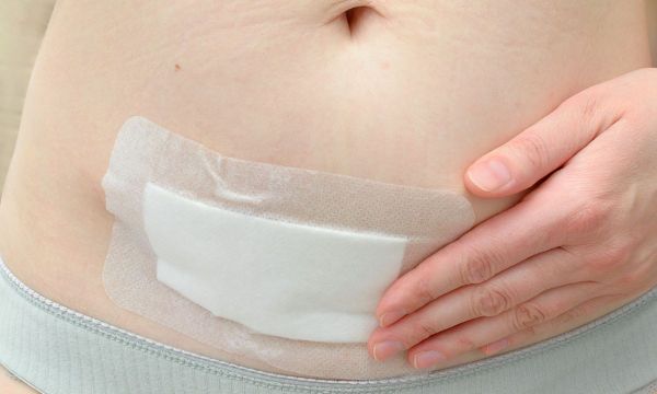 Ποια είναι τα σημάδια μόλυνσης μετά από μια καισαρική τομή;