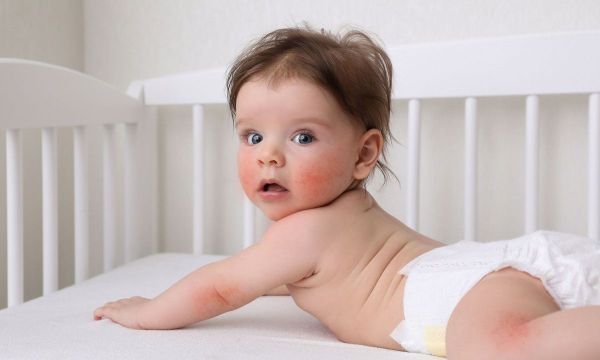 Κνίδωση στα μωρά: Αίτια και αντιμετώπιση