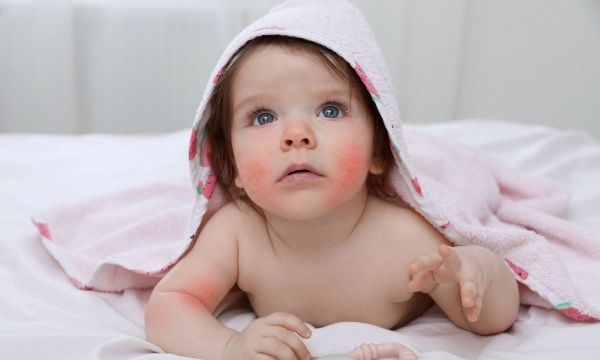 Νόσος χεριών, ποδιών και στόματος στα παιδιά: Τι να γνωρίζετε