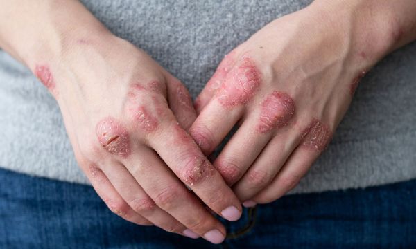 Χρόνιο έκζεμα χεριών: O FDA ενέκρινε την πρώτη κρέμα για τη θεραπεία της πάθησης