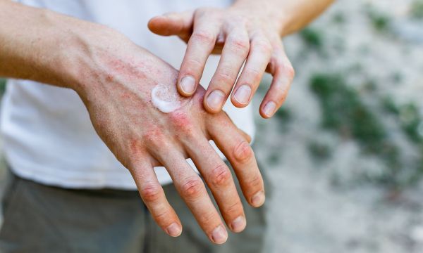 Η βιταμίνη που καταπραΰνει τα συμπτώματα της ψωρίασης - Πού θα την βρείτε