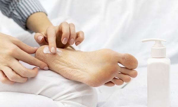 Σκασμένες φτέρνες: Γιατί εμφανίζονται και πώς να τις θεραπεύσετε με ασφάλεια