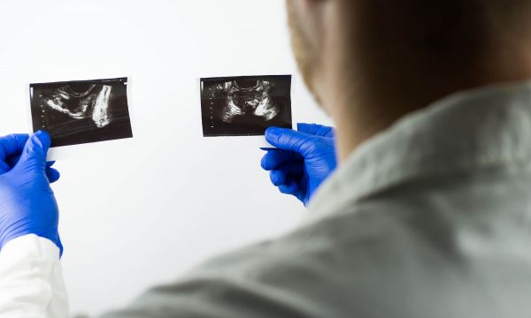 Καρκίνος προστάτη: Έρευνα έδειξε ότι μπορεί να ανιχνευθεί με ταχύτερες τομογραφίες 10 μόλις λεπτών