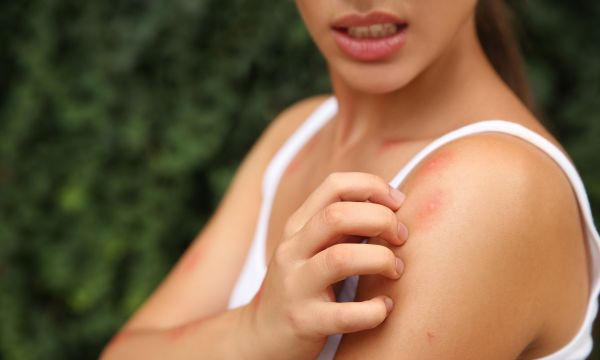 Σήψη από μολυσμένο τσίμπημα εντόμου: Τα σημάδια και πότε να πάτε στα Επείγοντα