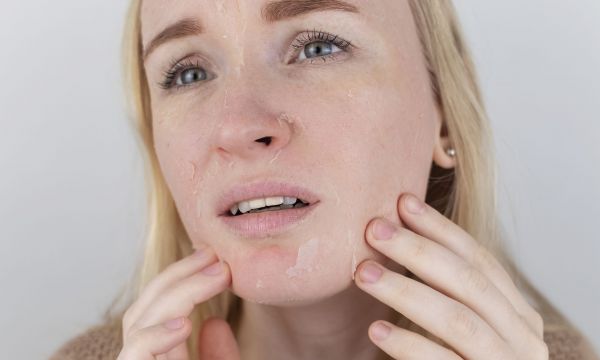 Μήπως βγάλατε το “εξάνθημα του χειμώνα” τώρα που κρύωσε ο καιρός;