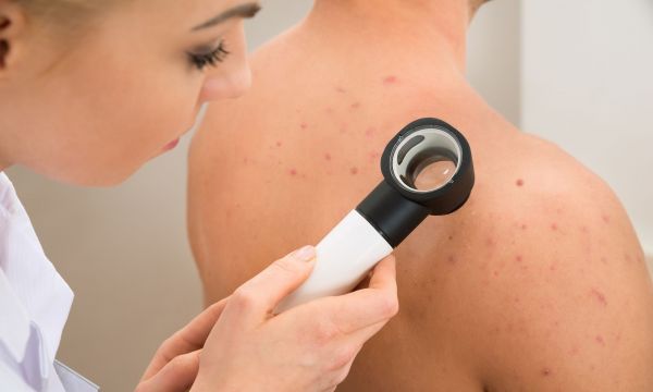 Διαπυητική ιδρωταδενίτιδα: Η δερματική πάθηση που συχνά συγχέεται με ακμή