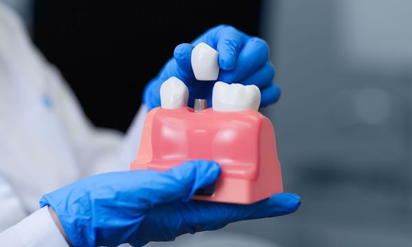 Προσοχή σε εμφυτεύματα χαμηλού κόστους - Οι οδοντίατροι προειδοποιούν για παραπλάνηση του κοινού