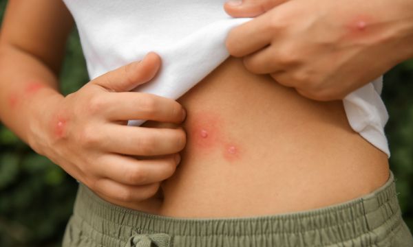 Τι δείχνει αν βγάλετε έκζεμα στο στομάχι – Τι να προσέχετε