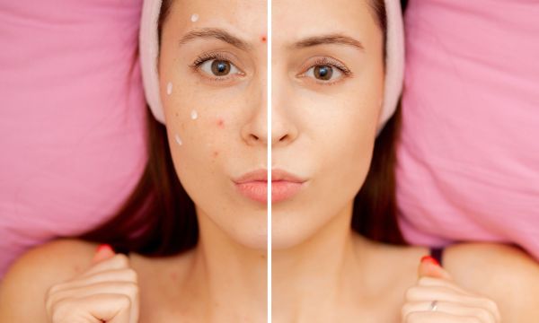 Είναι η υδροκορτιζόνη μια καλή θεραπεία για την ακμή;