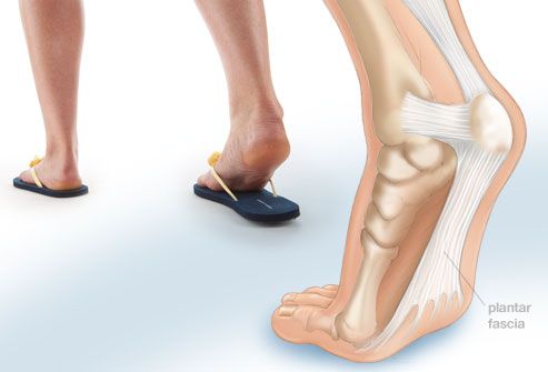 4webmd rf photo of plantar fasciitis